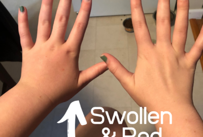 IV Infection Image